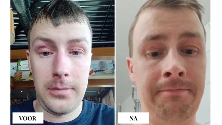 Eczeem gezicht