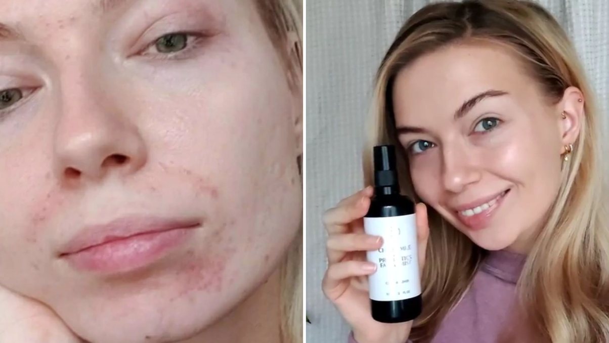 Dermatitis perioralis natuurlijke behandeling
