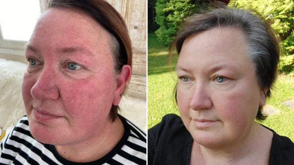 Retinol before and after