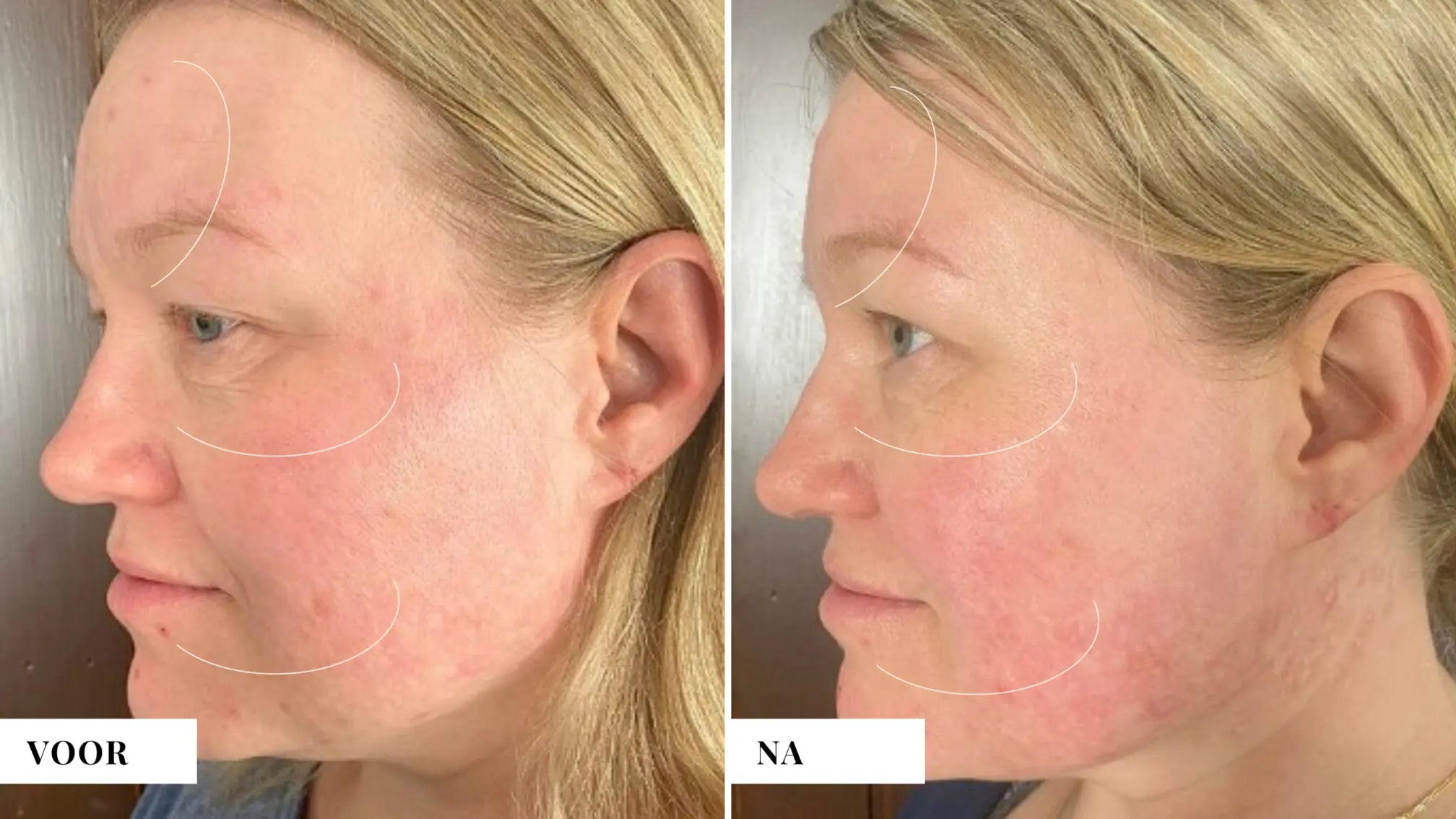 Rimpels verminderen zonder botox
