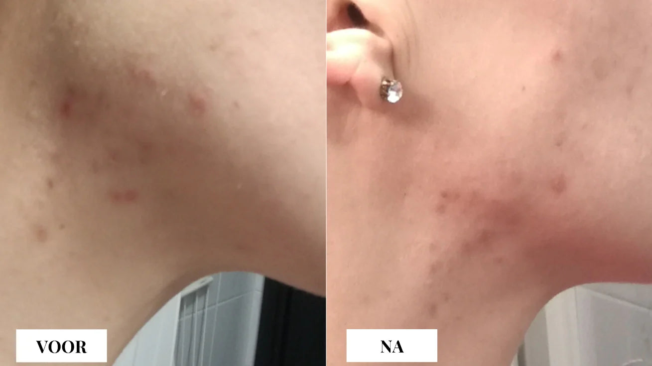 Tea tree olie werking