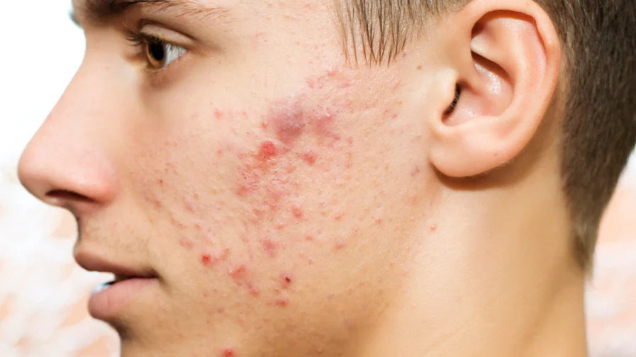 Acne behandeling thuis