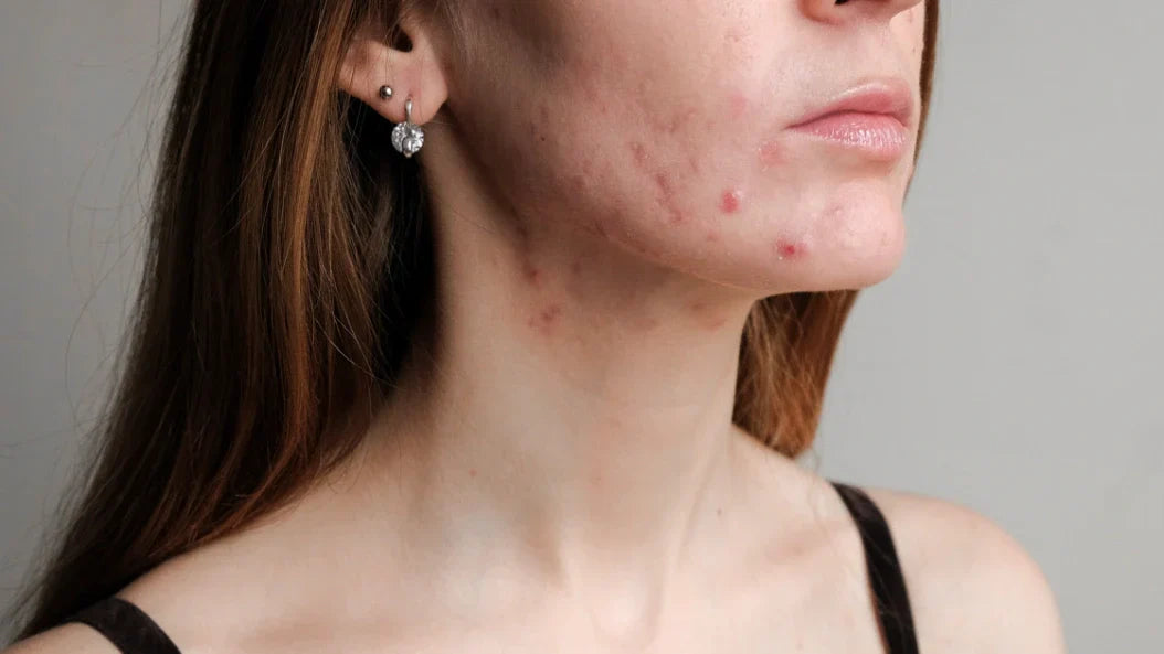 Beste acne behandeling