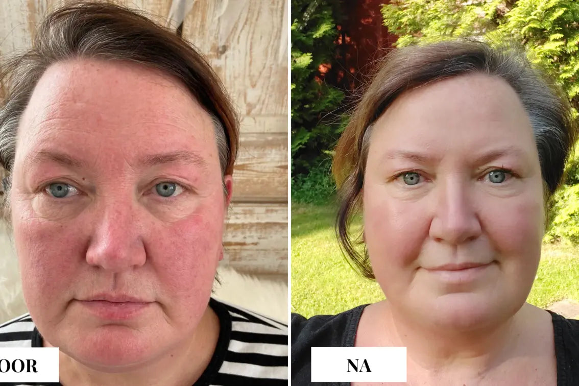 Rosacea natuurlijk behandelen