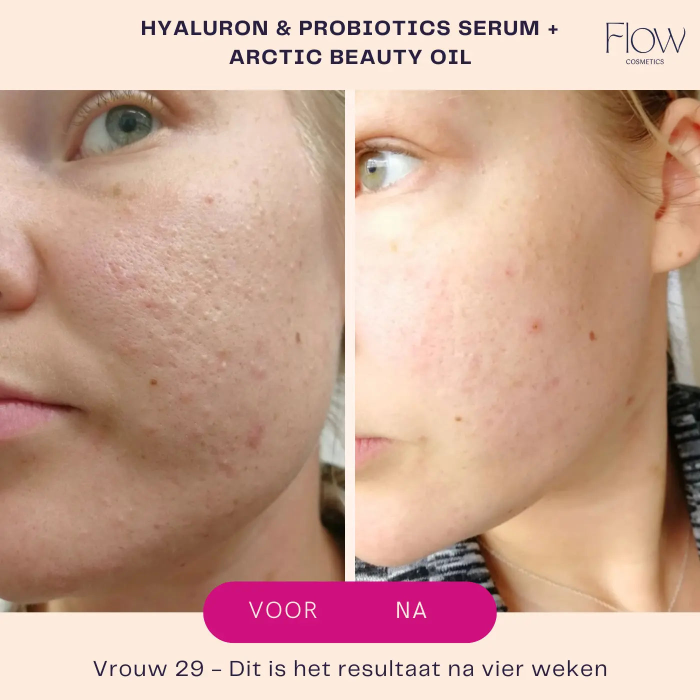 Hyaluronzuur serum results