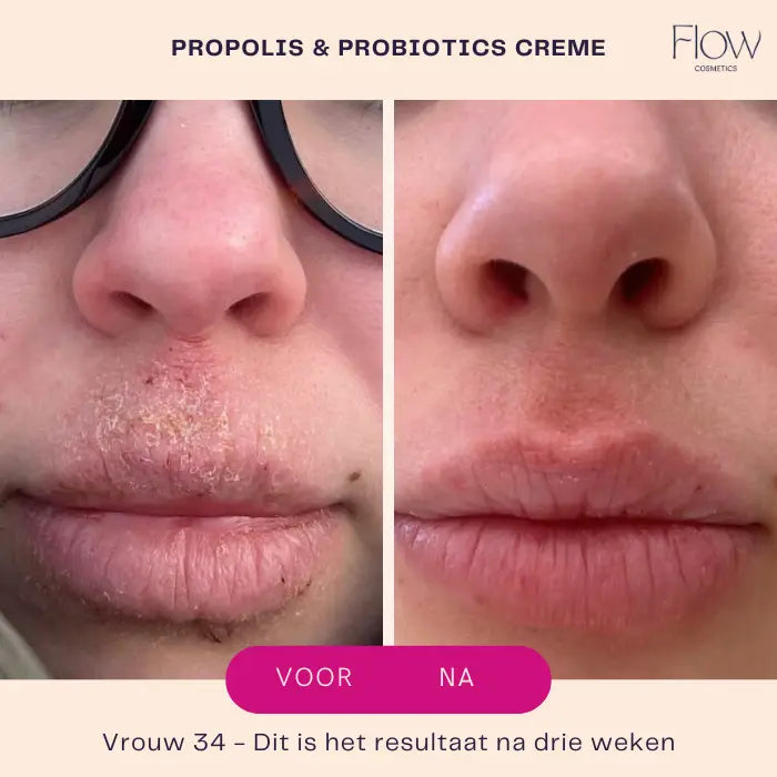 Propoliscreme results