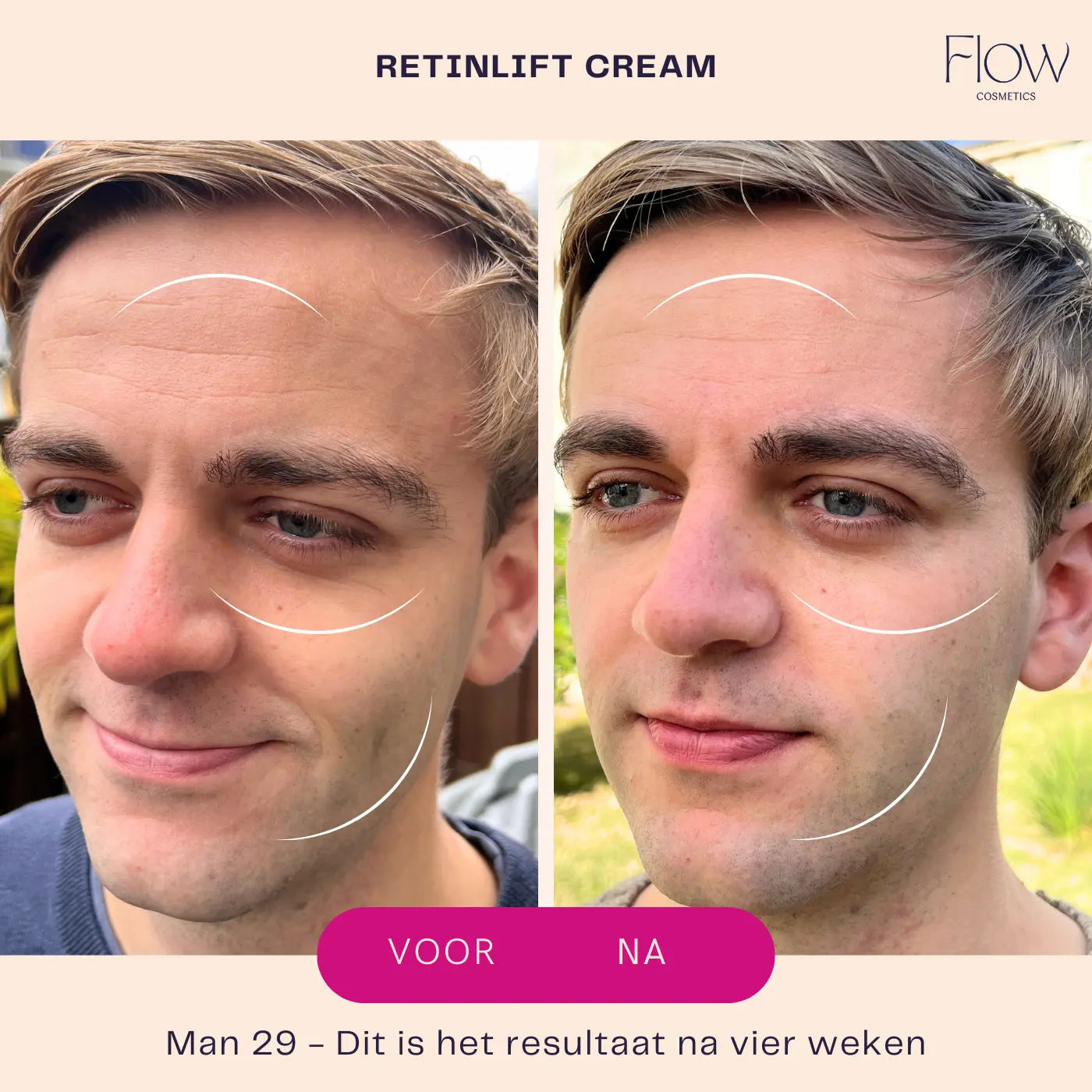 Retinlift before after