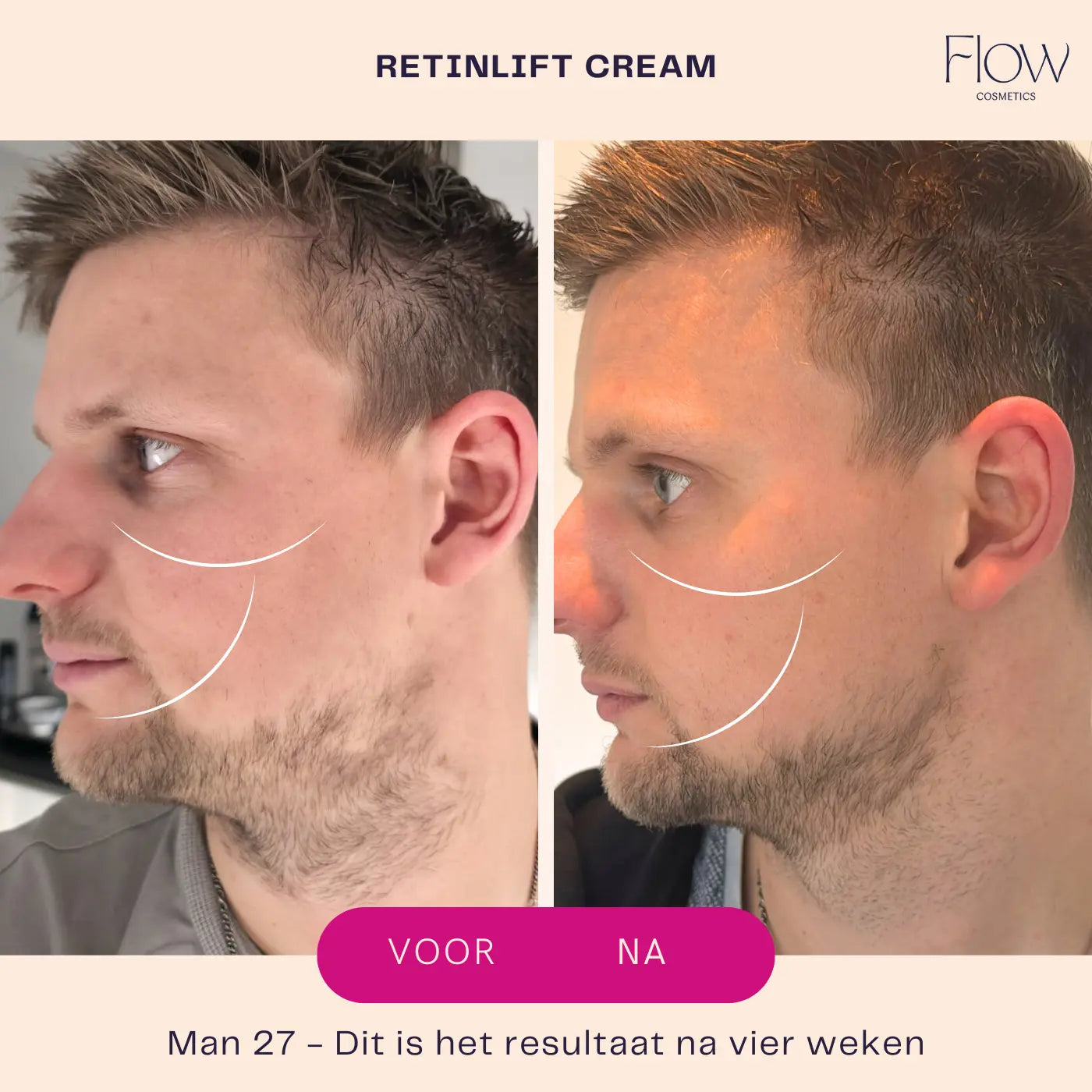 Retinlift-results