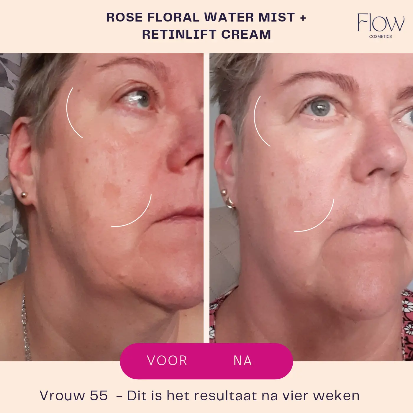 retinol before after