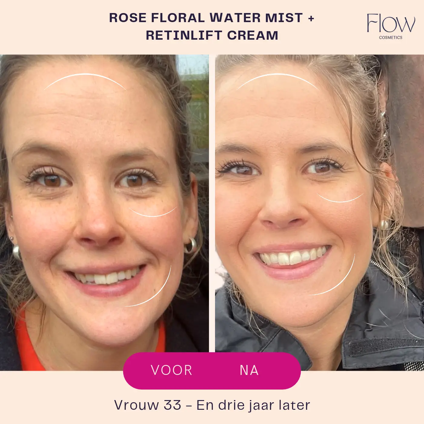 Retinol voor en na